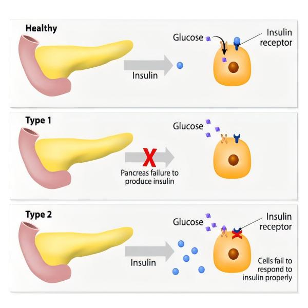 Program Rehabilitasi Gizi Diabetes